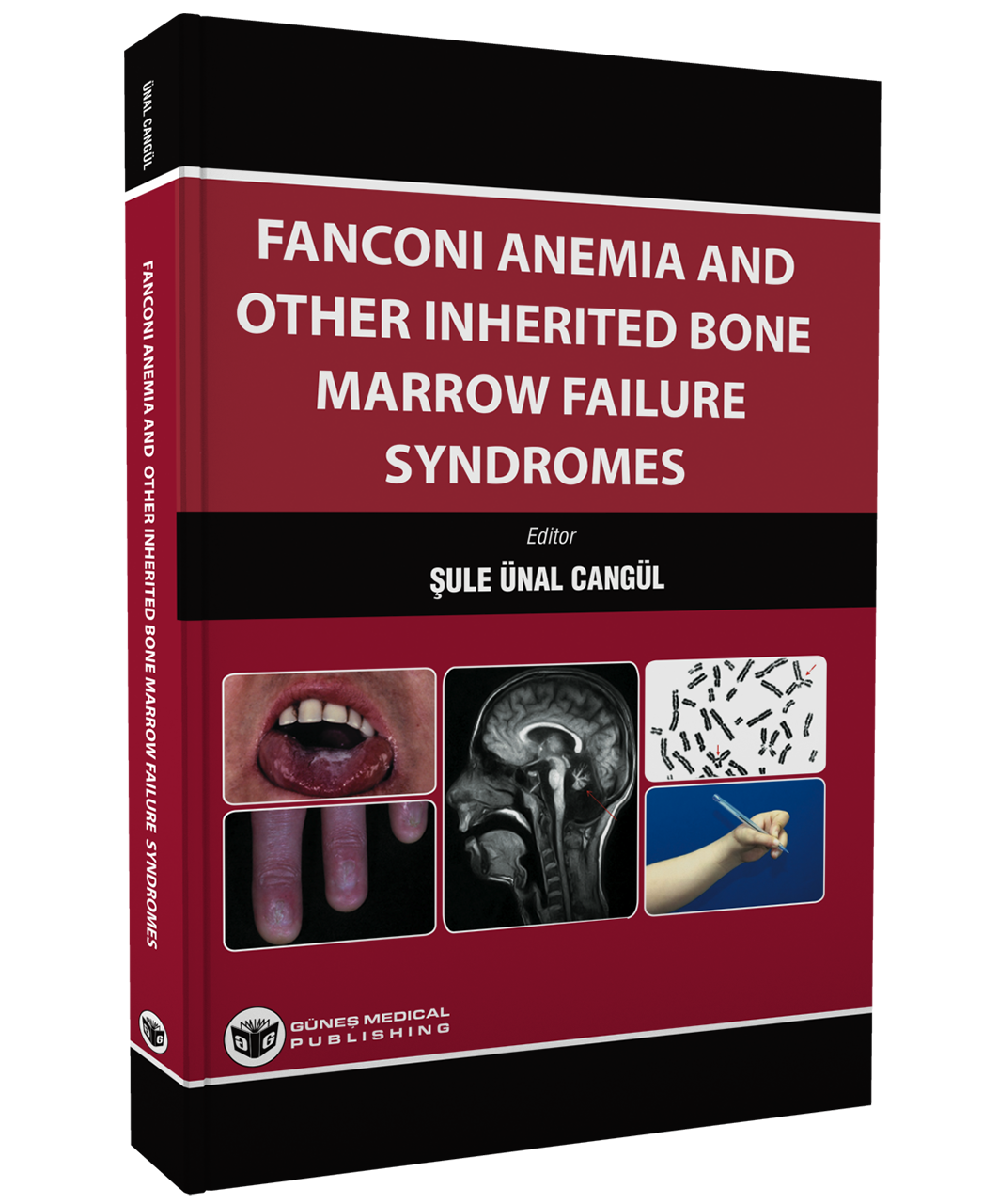 Fanconi Anemia And Other Inherited Bone Marrow Failure Syndromes