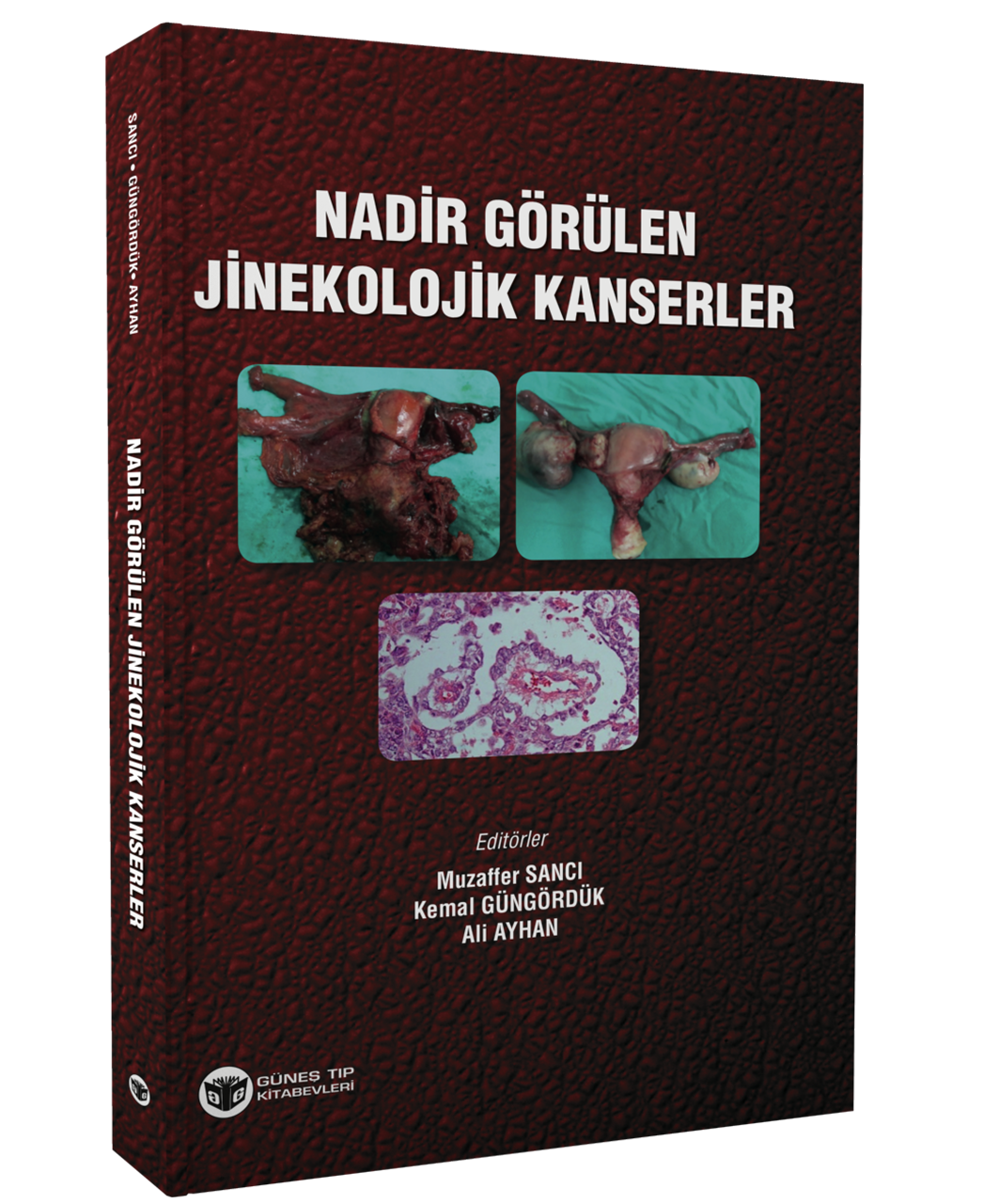 Nadir Görülen Jinekolojik Kanserler